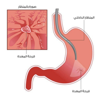مواضيع الموسوعة قرحة المعدة Gastric Ulcer