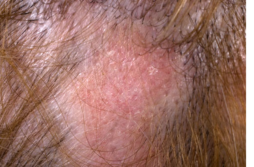 hair-loss-caused-by-lupus