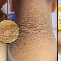 How To Remove Dark Circles And Wrinkles Around The Neck Very Fast!