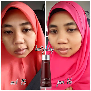 Testimoni Vivix Untuk Bell Palsy