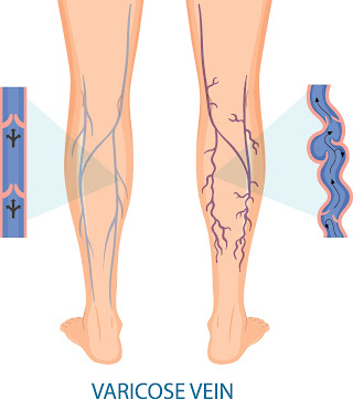 varicose veins treatment