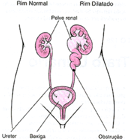 Cálculo renal