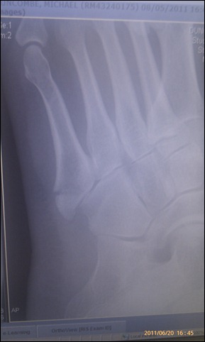 Left Foot showing broken 5th Metatarsal 8May2011