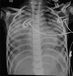   intercostal retractions, intercostal retractions ards, intercostal retractions treatment, intercostal recession definition, intercostal retractions causes, substernal retraction, intercostal retractions newborn, intercostal retractions in adults, intercostal retractions toddler