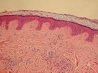 Epidermis and dermis