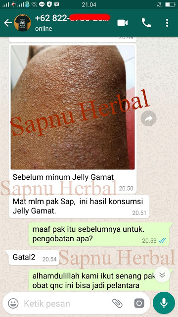 Cara Menghilangkan Gatal Bentol di Kemaluan Pria dan Wanita Paling Ampuh ~ TESTIMONI QNC JELLY GAMAT