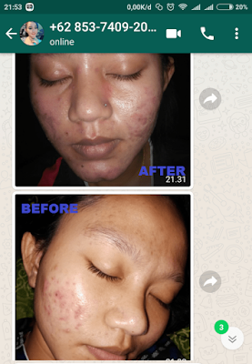 Testimoni Ertos Why Acne Toner