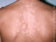 Nurul aida wahidah: penyakit kelainan pada kulit