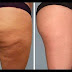 Remedies to Get Rid of Cellulite Dimples Naturally 