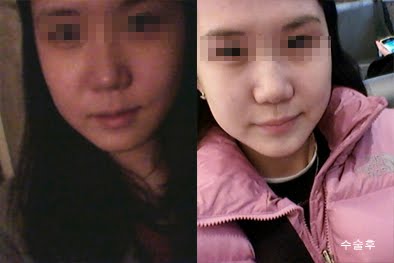 짱이뻐! - Transformed Into V-Line Face Thanks To Korea Face Contouring