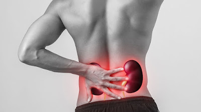 6 Symptoms of Kidney Stones And Risk Factors