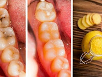 Cara Menghilangkan Sakit Gigi Pada Gigi Berlubang