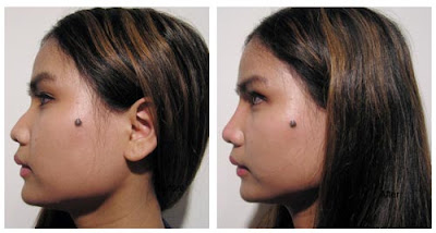Nose Surgery Pictures