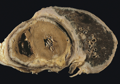 Diffuse pleural mesothelioma with extensive involvement of the pericardium