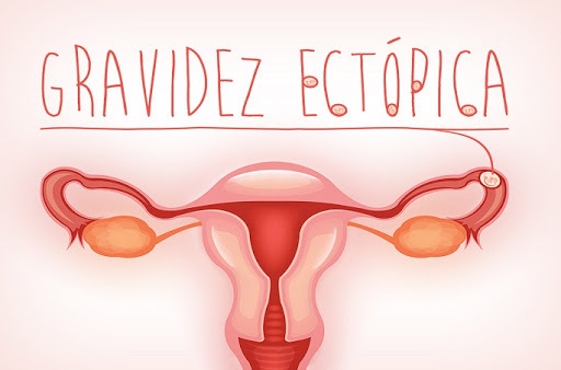 Covid-19 provoca aumento em quase seis vezes nos casos de gravidez ectópica