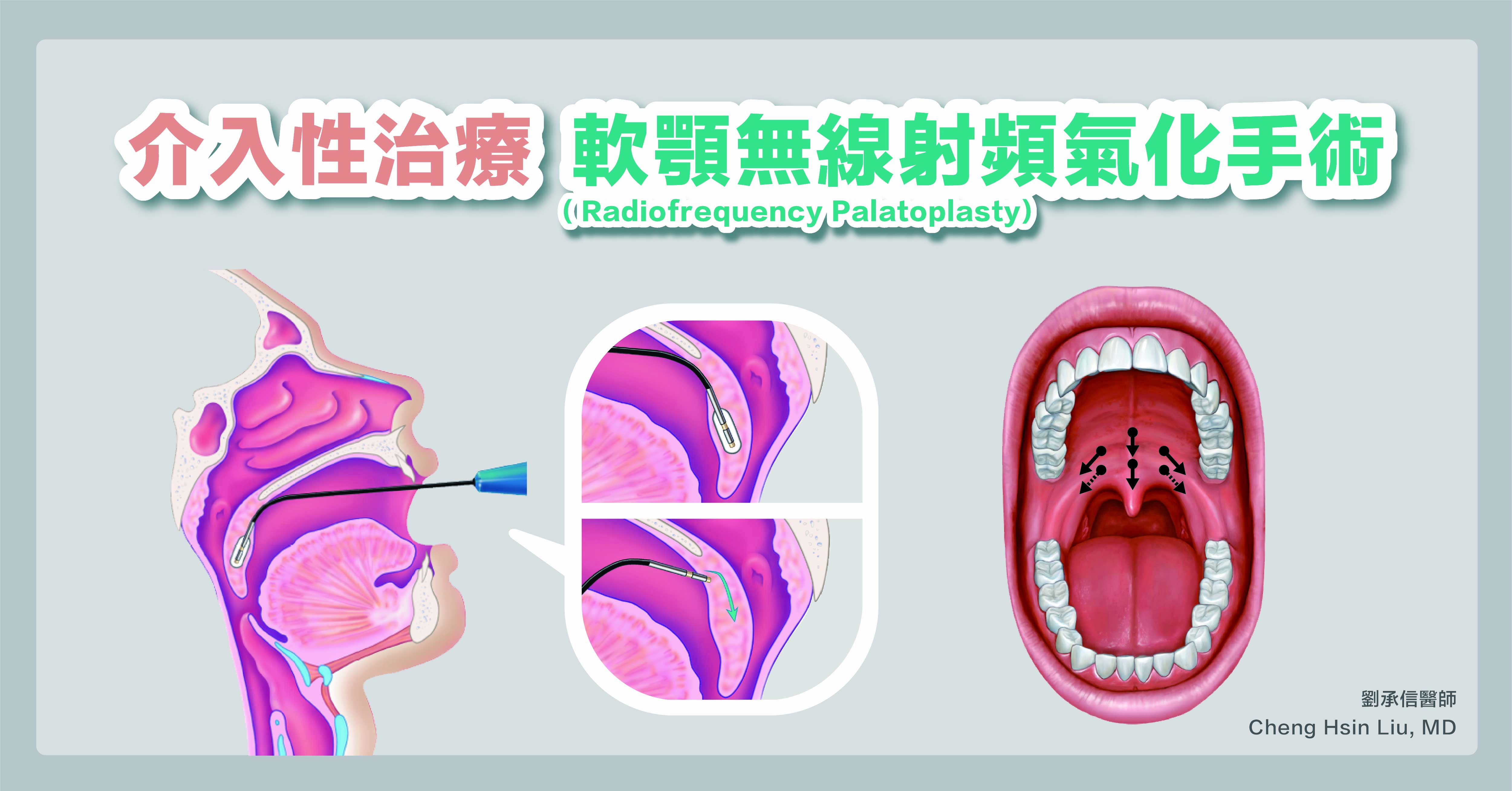 針對軟顎肥厚或塌陷造成的打鼾打呼，這種手術是新穎，且是相對安全有效的手術，疼痛感比其他的手術更低。雖然僅有少部分的人可以讓幾乎不再打呼，多數人可以有顯著的進步，足夠讓自己本身與同寢伴侶有感。