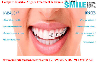 Best Orthodontist Braces Treatment Dental Clinic in Faridabad