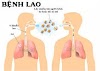 Bệnh lao ở Việt Nam nghiêm trọng và nguy hiểm như thế nào ?