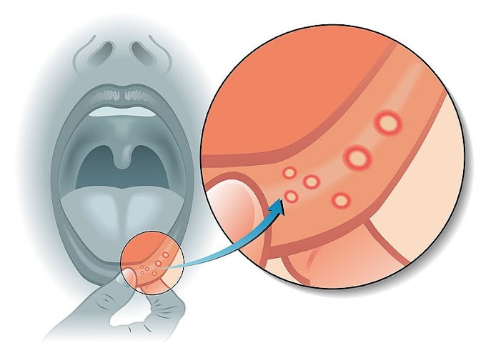 HERPES LABIAL: Más de la mitad de las personas en el mundo infectadas con herpes: OMS