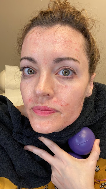 Immediately following the PRP facial, face is a bit red