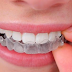 Niềng răng không mắc cài Invisalign