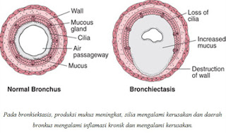 Bronkiektasis