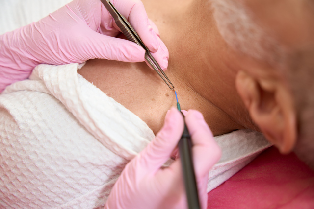 Câncer de pele representa cerca de 31% dos tumores malignos do Brasil