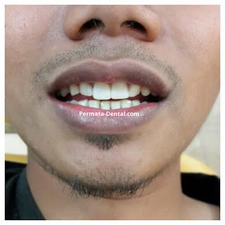 foto, gambar, gigi depan keropos Permata Dental Bali| sebelum dan sesudah gigi keropos diperbaiki di Permata Dental Bali | foto gigi keropos hitam Permata Dental Bali |gigi keropos karena sakit | gigi keropos berlubang | gigi keropos depan| gigi keropos bagian belakang | foto gigi keropos yang sudah diperbaiki Permata Dental Bali |  gigi keropos bagian depan| foto gigi keropos dan patah, foto gigi keropos oleh Permata Dental Bali, Bali Hits, Bali banget, area Bali, Bali kota, area kampus bali. veneer gigi keropos  Bali | veneer gigi keropos badung | veneer gigi keropos nusadua | veneer gigi keropos ngurahrai| veneer gigi keropos denpasar | veneer gigi kropos denpasar kota | veneer gigi keropos Bali | veneer gigi keropos gatsu | |veneer gigi keropos|  depan | veneer gigi keropos  atas | veneer gigi keropos  bawah | veneer gigi keropos  belakang |veneer gigi berlubang bali| veneer gigi berlubang Bali | veneer gigi berlubang nusadua| veneer gigi berlubang ngurahrai| veneer gigi berlubang Badung | veneer gigi berlubang depasar kota | veneer gigi berlubang denpasar| veneer gigi berlubang gatsu| veneer gigi berlubang jimbaran| veneer gigi berlubang bagus Permata Dental Bali | veneer gigi berlubang baik di Permata Dental Bali | veneer gigi berlubang cepat di Permata Dental Bali | veneer gigi berlubang murah di Permata Dental Bali | veneer gigi berlubang aman | veneer gigi berlubang mudah di Permata Dental Bali | veneer gigi berlubang promo Permata Dental Bali | gambar veneer gigi berlubang Permata Dental Bali | gambar sebelum dan sesudah veneer gigi hitam dan berlubang  veneer gigi hitam Bali | veneer gigi hitam Bali | veneer gigi hitam denpasar | veneer gigi hitam jimbaran | veneer gigi hitam nusadua | veneer gigi hitam Bali kota | veneer gigi hitam ngurahrai| veneer gigi hitam badung | veneer gigi hitam gatsu | veneer gigi hitam bagus | veneer gigi hitam baik | veneer gigi hitam cepat di Permata Dental Bali | veneer gigi hitam murah di Permata Dental Bali | veneer gigi hitam aman | veneer gigi hitam mudah di Permata Dental Bali | veneer gigi hitam promo Permata Dental Bali | gambar veneer gigi hitam Permata Dental Bali | gambar sebelum dan sesudah veneer gigi hitam dan berlubang Permata Dental