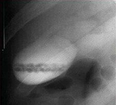 Contoh hasil kolesistografi pada kolelitiasis, duktus koledokus, duktus sistikus, batu empedu, gallstone, pemeriksaan penunjang, diagnosis