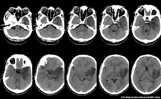 CVT%2BVS%2BGLIOMA.jpg