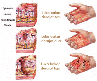 Kulit Terbakar tahap 1; cara mengubatinya