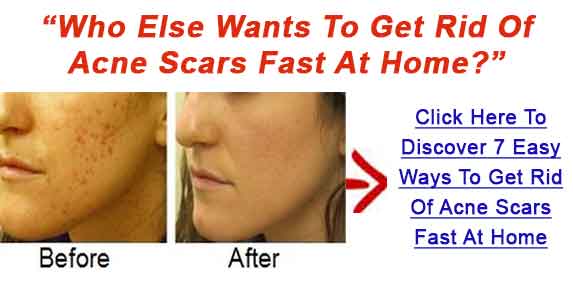 Get Rid Of Pimple Scars Fast - Heal Acne Marks Easily: How To Get Rid 