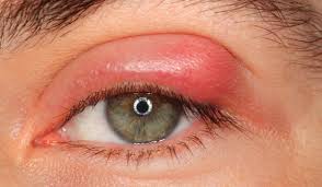 علاج الكيس الدهني في العين واسبابه والمخاطر المحتملة بعد الجراحة