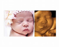 3d Ultrasound Pictures5