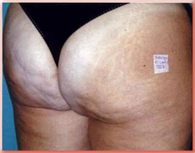 Cellulite on Butt