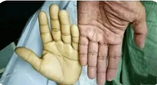 महिलाओं में एनीमिया,आयरन ही नहीं प्रोटीन की कमी से भी होता है,प्रोटीन भी है एनीमिया का कारण,एनीमिया के लक्षण