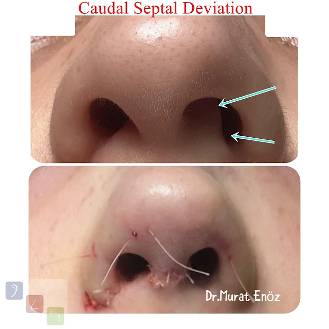 Severe anterior septal deviation,Anterior septal dislocation,septoplasty in istanbul,Caudal septal deviation,Severe nasal septum deviation,Open technique septoplasty operation,