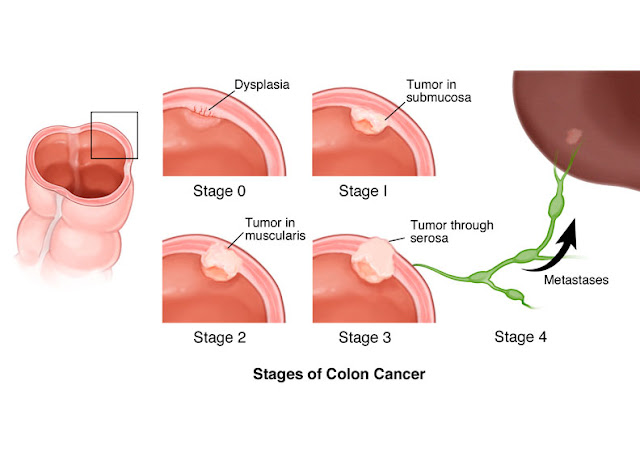 Does Colon Cancer Hurt?