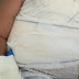 Criança derruba panela com óleo quente e sofre ferimentos graves, em Rosário do Ivaí