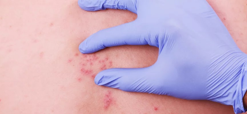 mengidentifikasi gejala herpes sejak dini kambuh