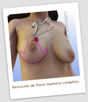 cirugia de levantamiento de senos o pexia mamaria. Salutaris Guadalajara Mexico