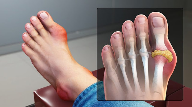 What is gout and what are its causes and methods of treatment | healthy care