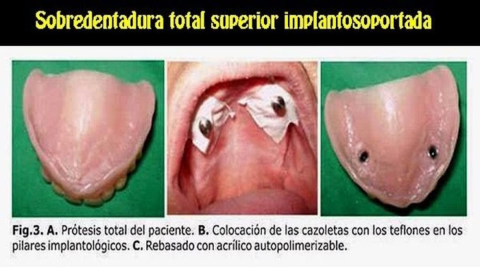 PDF: Sobredentadura total superior implantosoportada