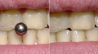 Dentes Danificados