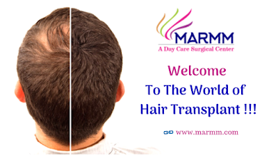 Hair transplant in Indore