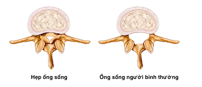 Tại sao bị hẹp ống sống ngực ?