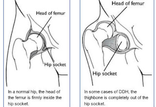 Cara menggendong bayi yang salah bisa menyebabkan terjadinya Hip Dysplasia yang pada bayi biasanya painless