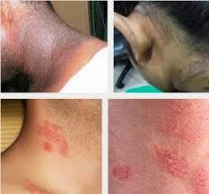  Cara Menghilangkan Gatal Eksim Di kaki dengan cepat dan aman