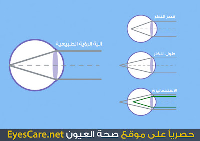 قصر النظر, طول النظر, الاستجماتيزم, موقع صحة العيون, النظارات الطبية