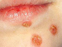 impetigo,cara mengobati gatal menahun